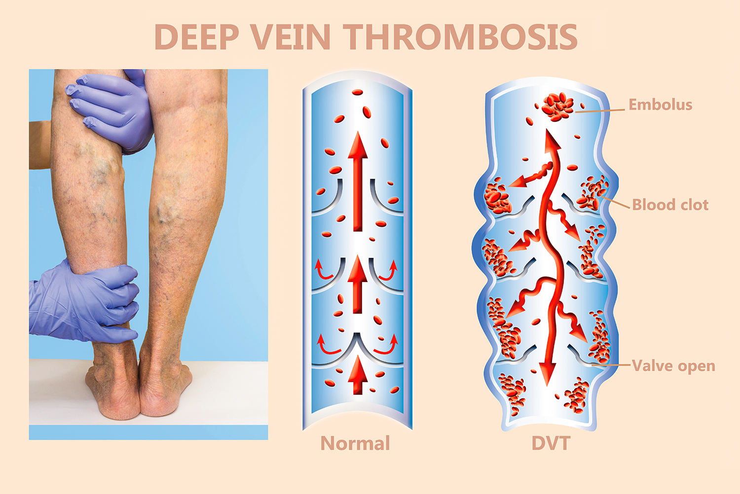 Blood Clot Risk And What You Can Do What Is Deep Vein Thrombosis Patientsengage